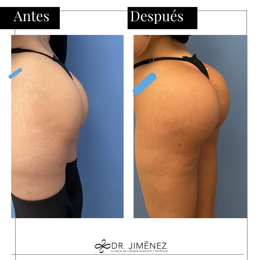 Before and After Result